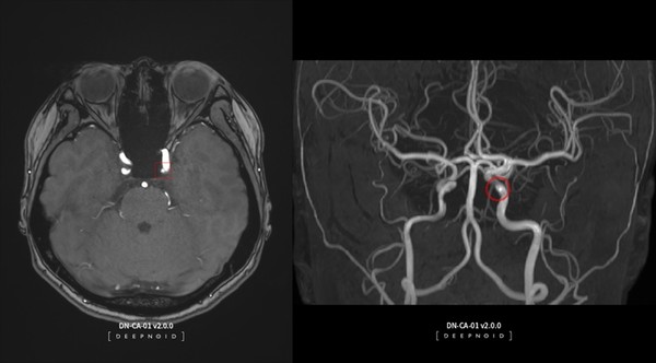 딥뉴로 뇌동맥류 검진 화면 [사진=딥노이드]