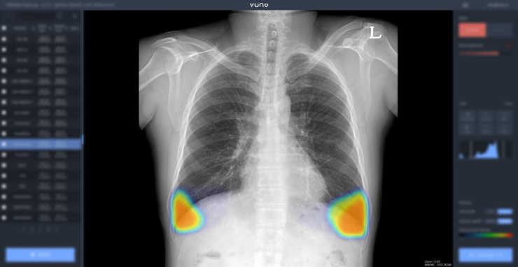 뷰노메드 체스트 엑스레이 실행 화면